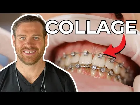 orthodontic bracket : quick bonding