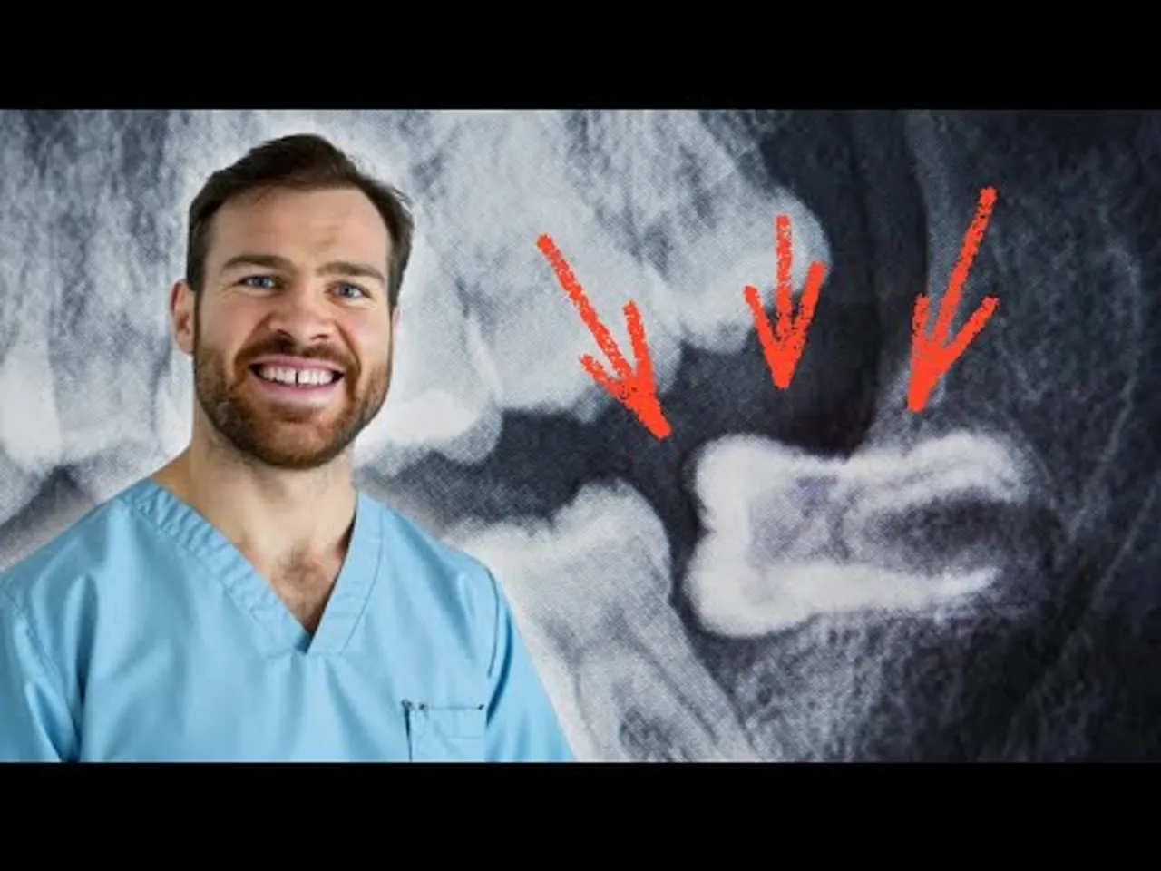 Dent de Sagesse, extraire ?